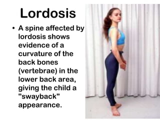Lordosis
• A spine affected by
lordosis shows
evidence of a
curvature of the
back bones
(vertebrae) in the
lower back area,
giving the child a
"swayback"
appearance.
 