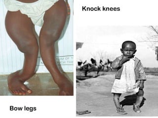 Knock knees
Bow legs
 
