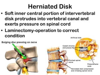 Herniated Disk
• Soft inner central portion of intervertebral
disk protrudes into vertebral canal and
exerts pressure on spinal cord
• Laminectomy-operation to correct
condition
 