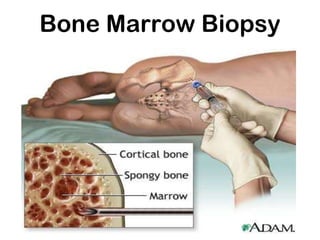 Bone Marrow Biopsy
 
