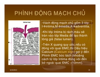 6/19/2013 10
PHÌNH ÑOÄNG MAÏCH CHUÛ
-Vaùch ñoäng maïch chuû goàm 3 lôùp:
I intima,M media,A adventitia.
-Khi lôùp Intima bò raùch,maùu seõ
traøn vaøo lôùp Media ñeå taïo thaønh
loøng giaû (false lumen).
-Treân X quang quy öôùc,neáu coù
ñoùng voâi quai ÑMC,thì Daáu hieäu
Calcium (Calcium sign) gôïi yù ñeán
Phình ÑMC boùc taùch (khoaûng
caùch töø lôùp Intima ñoùng voâi ñeán
bôø ngoaøi quai ÑMC >10mm).
 