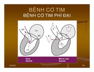6/19/2013 106
BEÄNH CÔ TIM
BEÄNH CÔ TIM PHÌ ÑAÏI
 