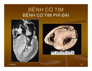 6/19/2013 107
BEÄNH CÔ TIM
BEÄNH CÔ TIM PHÌ ÑAÏI
 