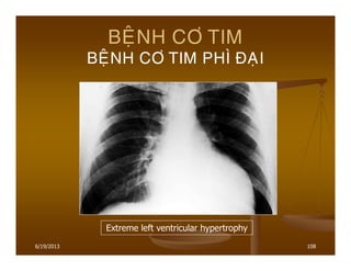 6/19/2013 108
BEÄNH CÔ TIM
BEÄNH CÔ TIM PHÌ ÑAÏI
Extreme left ventricular hypertrophy
 