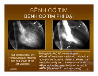6/19/2013 109
BEÄNH CÔ TIM
BEÄNH CÔ TIM PHÌ ÑAÏI
End-diastolic RAO left
ventriculogram Normal
size and shape of the
left ventricle.
End-systolic RAO left ventriculogram
Small left ventricular cavity with mild mitral
regurgitation.Increased distance between the
ventricular cavity and the coronary arteries
Myocardium becomes thickened in systole
HCM (Hypertrophic cardiomyopathy).
 