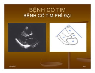 6/19/2013 110
BEÄNH CÔ TIM
BEÄNH CÔ TIM PHÌ ÑAÏI
 