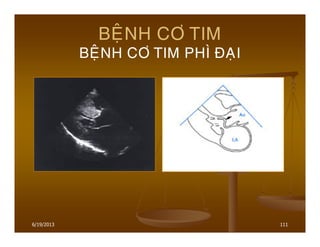 6/19/2013 111
BEÄNH CÔ TIM
BEÄNH CÔ TIM PHÌ ÑAÏI
 