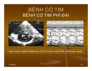 6/19/2013 112
BEÄNH CÔ TIM
BEÄNH CÔ TIM PHÌ ÑAÏI
Asymmetric septal thickening (23mm) and a small left ventricular cavity.
 