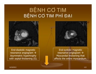 6/19/2013 113
BEÄNH CÔ TIM
BEÄNH CÔ TIM PHÌ ÑAÏI
End-diastolic magnetic
resonance angiogram
Asymmetric hypertrophy
with septal thickening (S).
End-systolic magnetic
resonance angiogram
Myocardial thickening that
affects the entire myocardium.
 