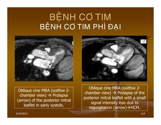 6/19/2013 114
BEÄNH CÔ TIM
BEÄNH CÔ TIM PHÌ ÑAÏI
Oblique cine MRA (outfow 2-
chamber view) Prolapse
(arrow) of the posterior mitral
leaflet in early systole.
Oblique cine MRA (outfow 2-
chamber view) Prolapse of the
posterior mitral leaflet with a small
signal intensity loss due to
regurgitation (arrow) HCM.
 