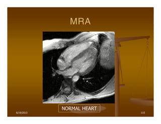 6/19/2013 115
MRA
NORMAL HEART
 