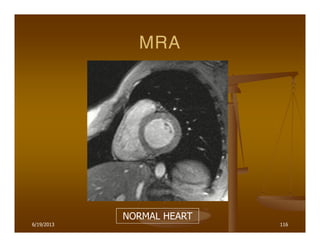 6/19/2013 116
MRA
NORMAL HEART
 