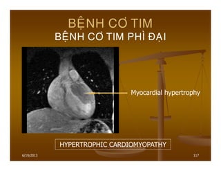 6/19/2013 117
BEÄNH CÔ TIM
BEÄNH CÔ TIM PHÌ ÑAÏI
HYPERTROPHIC CARDIOMYOPATHY
Myocardial hypertrophy
 