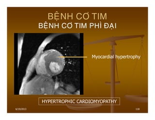 6/19/2013 118
BEÄNH CÔ TIM
BEÄNH CÔ TIM PHÌ ÑAÏI
HYPERTROPHIC CARDIOMYOPATHY
Myocardial hypertrophy
 
