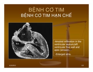 6/19/2013 123
BEÄNH CÔ TIM
BEÄNH CÔ TIM HAÏN CHEÁ
-Amyloid infiltration in the
ventricular septum,left
ventricular free wall and
apex (arrows).
-Enlarged atria.
 