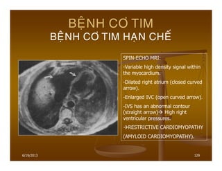 6/19/2013 129
BEÄNH CÔ TIM
BEÄNH CÔ TIM HAÏN CHEÁ
SPIN-ECHO MRI:
-Variable high density signal within
the myocardium.
-Dilated right atrium (closed curved
arrow).
-Enlarged IVC (open curved arrow).
-IVS has an abnormal contour
(straight arrow) High right
ventricular pressures.
RESTRICTIVE CARDIOMYOPATHY
(AMYLOID CARDIOMYOPATHY).
 