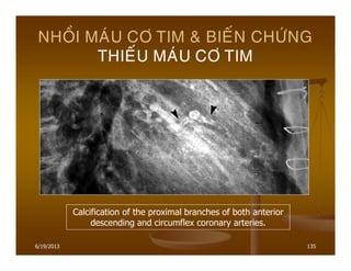6/19/2013 135
NHOÀI MAÙU CÔ TIM & BIEÁN CHÖÙNG
THIEÁU MAÙU CÔ TIM
Calcification of the proximal branches of both anterior
descending and circumflex coronary arteries.
 