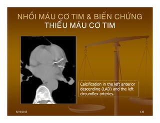6/19/2013 136
NHOÀI MAÙU CÔ TIM & BIEÁN CHÖÙNG
THIEÁU MAÙU CÔ TIM
Calcification in the left anterior
descending (LAD) and the left
circumflex arteries.
 