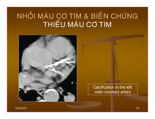6/19/2013 137
NHOÀI MAÙU CÔ TIM & BIEÁN CHÖÙNG
THIEÁU MAÙU CÔ TIM
Calcification in the left
main coronary artery
 