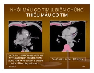 6/19/2013 138
NHOÀI MAÙU CÔ TIM & BIEÁN CHÖÙNG
THIEÁU MAÙU CÔ TIM
COLORS ALL STRUCTURES WITH AN
ATTENUATION OF GREATER THAN
130HU PINK No calcium is present
in the LAD or diagonal branch.
Calcification in the LAD artery.
 