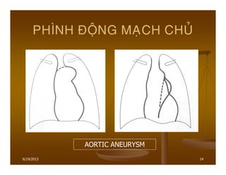 6/19/2013 14
PHÌNH ÑOÄNG MAÏCH CHUÛ
AORTIC ANEURYSM
 