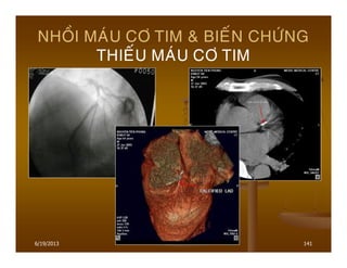 6/19/2013 141
NHOÀI MAÙU CÔ TIM & BIEÁN CHÖÙNG
THIEÁU MAÙU CÔ TIM
 