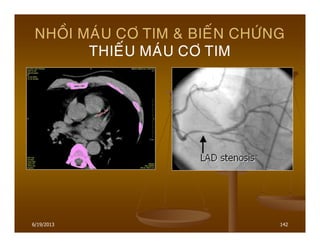 6/19/2013 142
NHOÀI MAÙU CÔ TIM & BIEÁN CHÖÙNG
THIEÁU MAÙU CÔ TIM
 