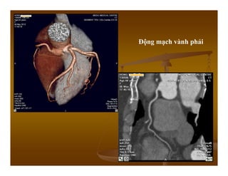 Động mạch vành phải
 