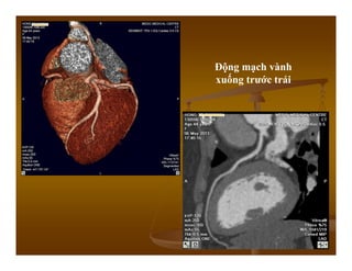 Động mạch vành
xuống trước trái
 