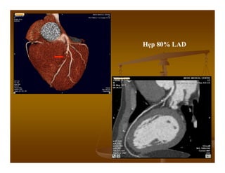 Hẹp 80% LAD
 