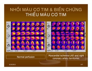 6/19/2013 147
NHOÀI MAÙU CÔ TIM & BIEÁN CHÖÙNG
THIEÁU MAÙU CÔ TIM
Normal perfusion
Myocardial ischemia:LAD and right
coronary artery territories.
 