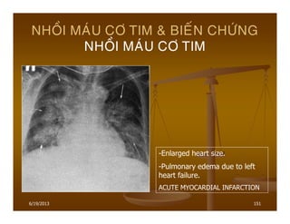 6/19/2013 151
NHOÀI MAÙU CÔ TIM & BIEÁN CHÖÙNG
NHOÀI MAÙU CÔ TIM
-Enlarged heart size.
-Pulmonary edema due to left
heart failure.
ACUTE MYOCARDIAL INFARCTION
 