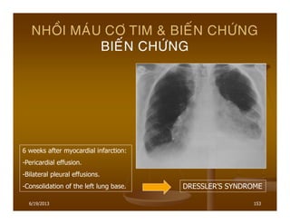 6/19/2013 153
NHOÀI MAÙU CÔ TIM & BIEÁN CHÖÙNG
BIEÁN CHÖÙNG
6 weeks after myocardial infarction:
-Pericardial effusion.
-Bilateral pleural effusions.
-Consolidation of the left lung base. DRESSLER’S SYNDROME
 