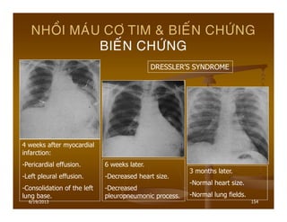 6/19/2013 154
NHOÀI MAÙU CÔ TIM & BIEÁN CHÖÙNG
BIEÁN CHÖÙNG
4 weeks after myocardial
infarction:
-Pericardial effusion.
-Left pleural effusion.
-Consolidation of the left
lung base.
6 weeks later.
-Decreased heart size.
-Decreased
pleuropneumonic process.
3 months later.
-Normal heart size.
-Normal lung fields.
DRESSLER’S SYNDROME
 
