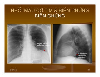 6/19/2013 157
NHOÀI MAÙU CÔ TIM & BIEÁN CHÖÙNG
BIEÁN CHÖÙNG
 