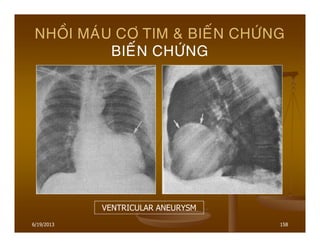 6/19/2013 158
NHOÀI MAÙU CÔ TIM & BIEÁN CHÖÙNG
BIEÁN CHÖÙNG
VENTRICULAR ANEURYSM
 