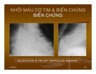 6/19/2013 159
NHOÀI MAÙU CÔ TIM & BIEÁN CHÖÙNG
BIEÁN CHÖÙNG
CALCIFICATION IN THE LEFT VENTRICULAR ANEURYSM
 