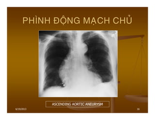 6/19/2013 16
PHÌNH ÑOÄNG MAÏCH CHUÛ
ASCENDING AORTIC ANEURYSM
 