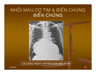 6/19/2013 160
NHOÀI MAÙU CÔ TIM & BIEÁN CHÖÙNG
BIEÁN CHÖÙNG
CALCIFIED RIGHT VENTRICULAR ANEURYSM
 