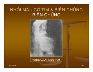 6/19/2013 161
NHOÀI MAÙU CÔ TIM & BIEÁN CHÖÙNG
BIEÁN CHÖÙNG
VENTRICULAR ANEURYSM
 