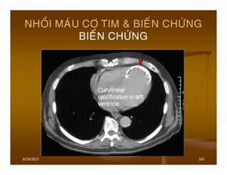 6/19/2013 162
NHOÀI MAÙU CÔ TIM & BIEÁN CHÖÙNG
BIEÁN CHÖÙNG
 