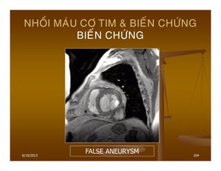 6/19/2013 164
NHOÀI MAÙU CÔ TIM & BIEÁN CHÖÙNG
BIEÁN CHÖÙNG
FALSE ANEURYSM
 