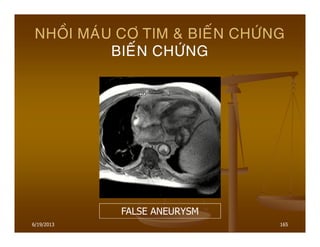6/19/2013 165
NHOÀI MAÙU CÔ TIM & BIEÁN CHÖÙNG
BIEÁN CHÖÙNG
FALSE ANEURYSM
 