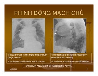 6/19/2013 17
PHÌNH ÑOÄNG MAÏCH CHUÛ
-Saccular mass in the right mediastinum
(large arrows).
-Curvilinear calcification (small arrow).
-The trachea is displaced posteriorly
(double black arrows).
-Curvilinear calcification (small arrow).
SACCULAR ANEURYSM OF ASCENDING AORTA
 