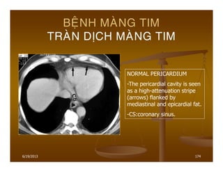 6/19/2013 174
BEÄNH MAØNG TIM
TRAØN DÒCH MAØNG TIM
NORMAL PERICARDIUM
-The pericardial cavity is seen
as a high-attenuation stripe
(arrows) flanked by
mediastinal and epicardial fat.
-CS:coronary sinus.
 