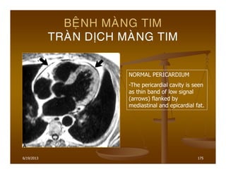 6/19/2013 175
BEÄNH MAØNG TIM
TRAØN DÒCH MAØNG TIM
NORMAL PERICARDIUM
-The pericardial cavity is seen
as thin band of low signal
(arrows) flanked by
mediastinal and epicardial fat.
 