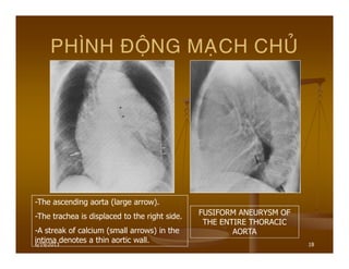 6/19/2013 18
PHÌNH ÑOÄNG MAÏCH CHUÛ
-The ascending aorta (large arrow).
-The trachea is displaced to the right side.
-A streak of calcium (small arrows) in the
intima denotes a thin aortic wall.
FUSIFORM ANEURYSM OF
THE ENTIRE THORACIC
AORTA
 