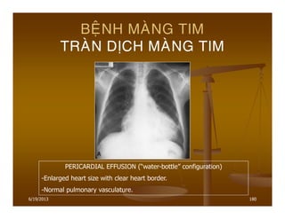 6/19/2013 180
BEÄNH MAØNG TIM
TRAØN DÒCH MAØNG TIM
PERICARDIAL EFFUSION (“water-bottle” configuration)
-Enlarged heart size with clear heart border.
-Normal pulmonary vasculature.
 