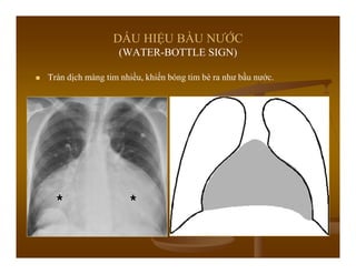 DẤU HIỆU BẦU NƯỚC
(WATER-BOTTLE SIGN)
Tràn dịch màng tim nhiều, khiến bóng tim bè ra như bầu nước.
 