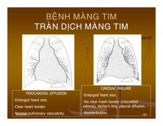 6/19/2013 182
BEÄNH MAØNG TIM
TRAØN DÒCH MAØNG TIM
PERICARDIAL EFFUSION
-Enlarged heart size.
-Clear heart border.
-Normal pulmonary vascularity.
CARDIAC FAILURE
-Enlarged heart size.
-No clear heart border (interstitiel
edema), Kerley’s line, pleural effusion.
-Redistribution.
 